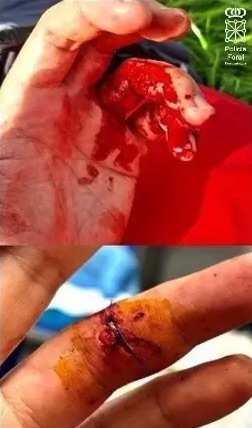 Dos policías forales heridos tras ser agredidos y mordidos en una persecución a pie en Uharte-Arakil